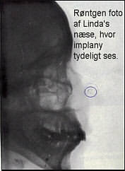 Røntgenfoto af Linda næse